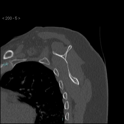 Avascular necrosis of the shoulder - Cruess stage I (Radiopaedia 77674-89887 Sagittal bone window 4).jpg