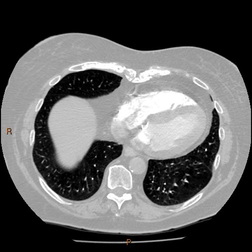 Azygos lobe (Radiopaedia 40161-42821 Axial lung window 54).jpg