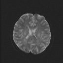 Balo concentric sclerosis (Radiopaedia 50458-55940 Axial DWI 32).jpg