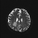Balo concentric sclerosis (Radiopaedia 50458-55940 Axial DWI 8).jpg