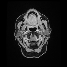 Balo concentric sclerosis (Radiopaedia 53875-59982 Axial LAVA C+ 10).jpg