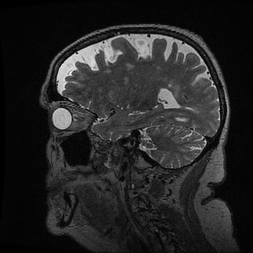Balo concentric sclerosis (Radiopaedia 53875-59982 Sagittal 3D FSE 192).jpg