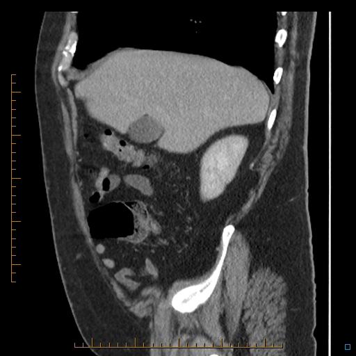 File:Bariatric balloon causing gastric outlet obstruction (Radiopaedia 54449-60672 C 63).jpg