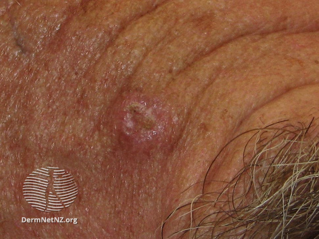 File:Basal cell carcinoma affecting the face (DermNet NZ lesions-bcc-face-0715).jpg