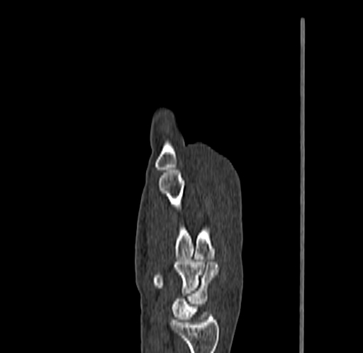Base of 2nd metacarpal fracture (Radiopaedia 73741-84544 Sagittal bone window 37).jpg