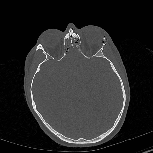 Base of skull fracture with bilateral Le Fort fractures (Radiopaedia 47094-51638 Axial bone window 44).jpg
