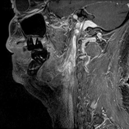 Base of tongue squamous cell carcinoma (Radiopaedia 31174-31884 F 123).jpg