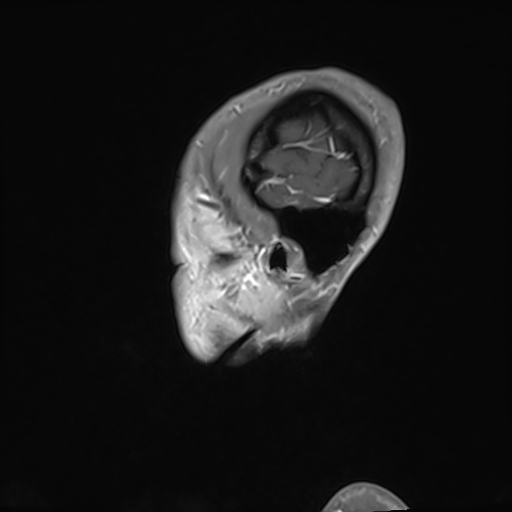 Basilar artery perforator aneurysm (Radiopaedia 82455-97733 G 136).jpg