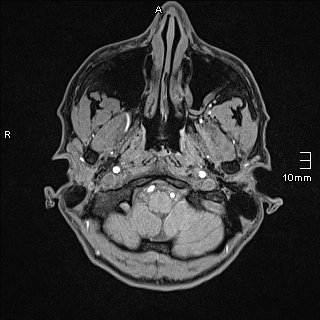 Basilar artery perforator aneurysm (Radiopaedia 82455-99523 F 2).jpg