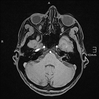Basilar artery perforator aneurysm (Radiopaedia 82455-99523 F 27).jpg
