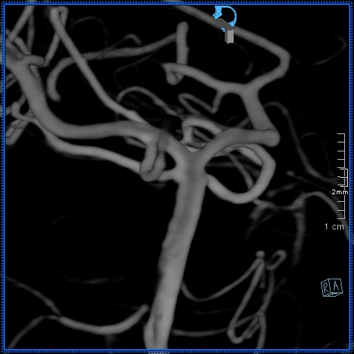 Basilar artery perforator aneurysm (Radiopaedia 82455-99524 3D Left VA 51).jpg