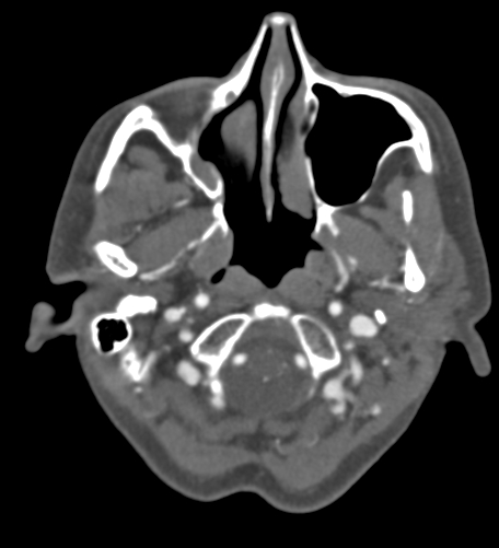 Basilar tip aneurysm with coiling (Radiopaedia 53912-60086 A 17).jpg