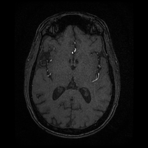 Basilar top and left middle cerebral artery aneurysm (Radiopaedia 61965-70031 Axial MRA 87).jpg