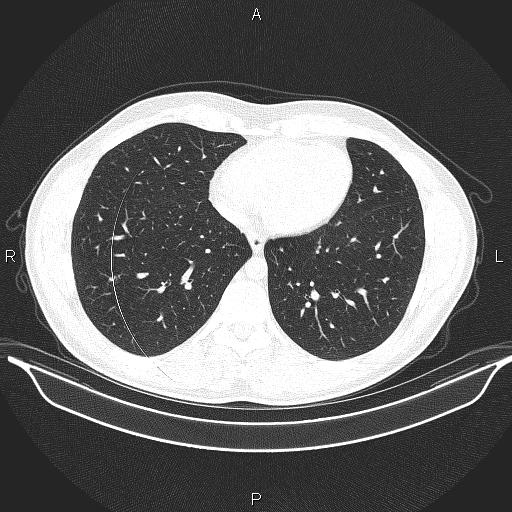 Beam hardening and ring artifacts (Radiopaedia 85323-100915 Axial lung window 55).jpg