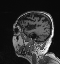 Behavioral variant frontotemporal dementia and late onset schizophrenia (Radiopaedia 52197-58083 Sagittal T1 10).png