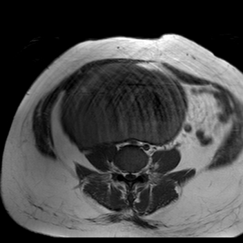 File:Benign seromucinous cystadenoma of the ovary (Radiopaedia 71065-81300 Axial T1 19).jpg