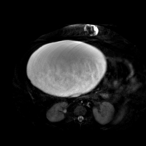 File:Benign seromucinous cystadenoma of the ovary (Radiopaedia 71065-81300 T2 SPAIR 30).jpg