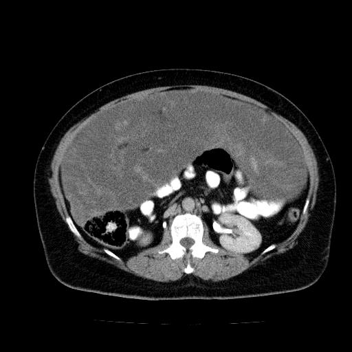 Benign spindle cell tumor - abdominopelvic (Radiopaedia 61300-69212 Axial C+ delayed 28).jpg