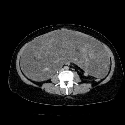 Benign spindle cell tumor - abdominopelvic (Radiopaedia 61300-69212 Axial C+ delayed 36).jpg