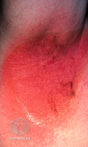File:Benzocaine allergy (DermNet NZ dermatitis-caine-ax).jpg