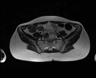 File:Bicornuate bicollis uterus (Radiopaedia 61626-69616 Axial T2 5).jpg