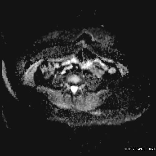 File:Bicornuate uterus- on MRI (Radiopaedia 49206-54297 Axial ADC 1).jpg