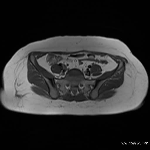 File:Bicornuate uterus- on MRI (Radiopaedia 49206-54297 Axial T1 1).jpg