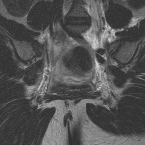 File:Bicornuate uterus (Radiopaedia 24677-24949 Coronal T2 16).jpg