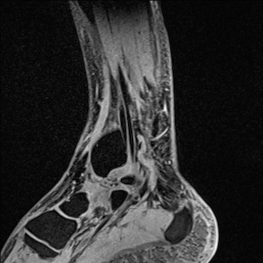 Bilateral Achilles tendon complete tear (Radiopaedia 81344-95051 Sagittal WE - Left 38).jpg
