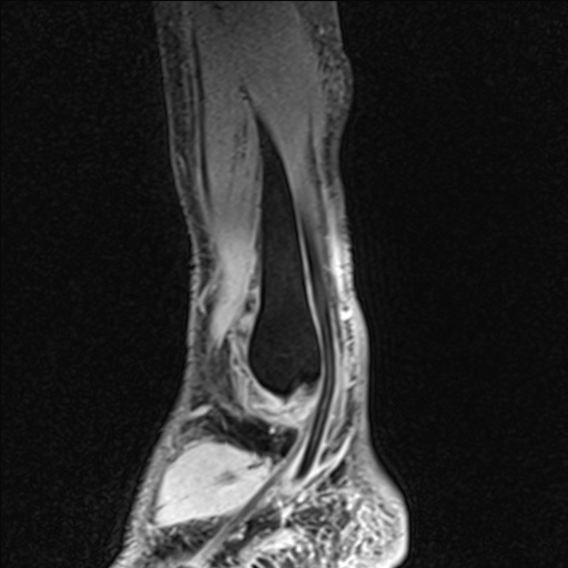 File:Bilateral Achilles tendon complete tear (Radiopaedia 81344-95051 Sagittal WE - Left 94).jpg