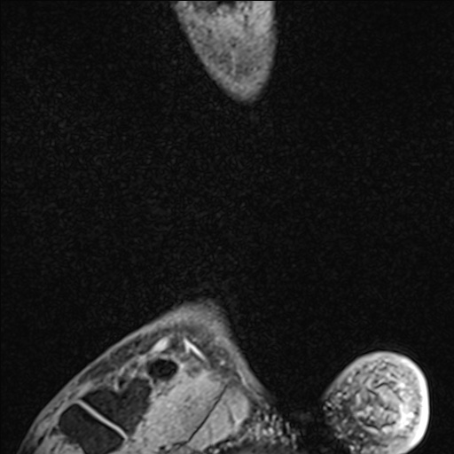 Bilateral Achilles tendon complete tear (Radiopaedia 81344-95051 Sagittal WE - Right 98).jpg