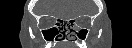 Bilateral Ectopic Infraorbital Nerves (Radiopaedia 49006-54084 Coronal bone window 38).jpg