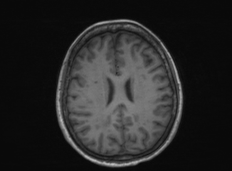 File:Bilateral PCA territory infarction - different ages (Radiopaedia 46200-51784 Axial T1 200).jpg