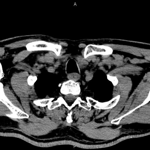 File:Bilateral Warthin tumors (Radiopaedia 84034-99263 Axial non-contrast 60).jpg