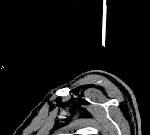 Bilateral Warthin tumors (Radiopaedia 84034-99263 D 6).jpg