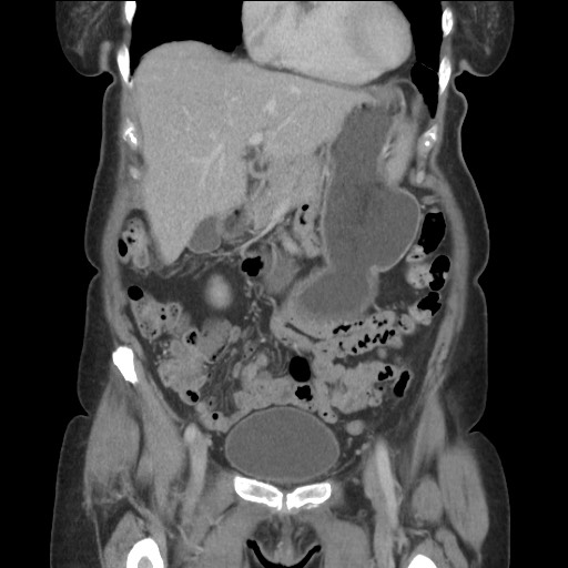 Bilateral adrenal granulocytic sarcomas (chloromas) (Radiopaedia 78375-91007 B 33).jpg