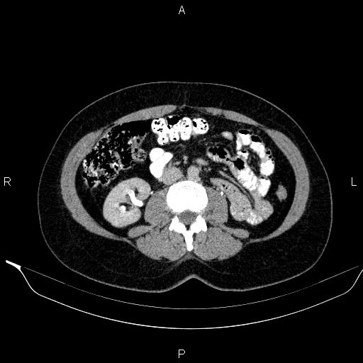 Bilateral adrenal myelolipoma (Radiopaedia 63058-71535 Axial C+ delayed 70).jpg
