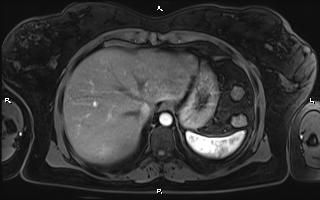Bilateral adrenal myelolipoma (Radiopaedia 63058-71537 Axial T1 C+ fat sat 18).jpg
