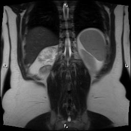 File:Bilateral adrenal myelolipoma (Radiopaedia 63058-71537 Coronal T2 4).jpg