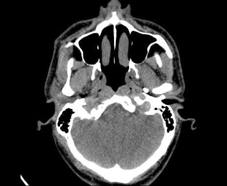 Bilateral carotid body tumors (Radiopaedia 61841-69870 Axial non-contrast 7).jpg