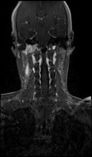 Bilateral carotid body tumors and right glomus jugulare tumor (Radiopaedia 20024-20060 MRA 46).jpg