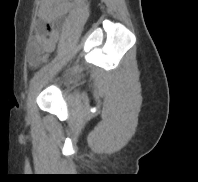 Bilateral mature cystic ovarian teratoma (Radiopaedia 88821-105592 D 59).jpg