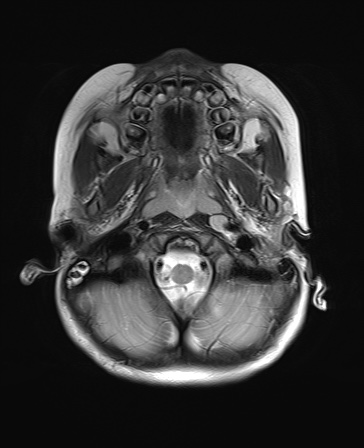 File:Bilateral mesial temporal polymicrogyria (Radiopaedia 76456-88181 Axial T2 2).jpg