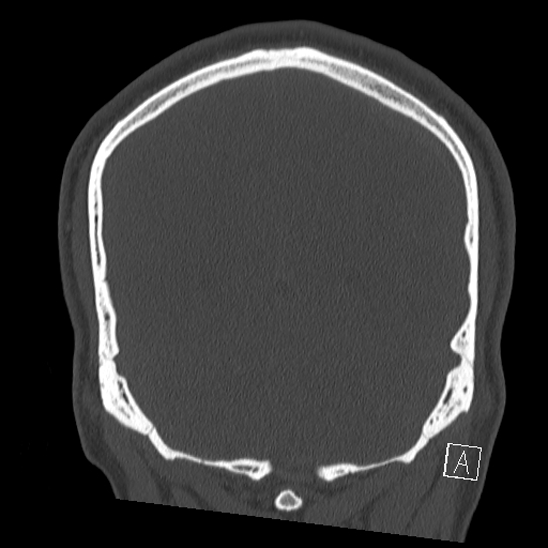 Bilateral occipital condyle fracture (type 2) (Radiopaedia 87675-104089 Coronal bone window 111).jpg