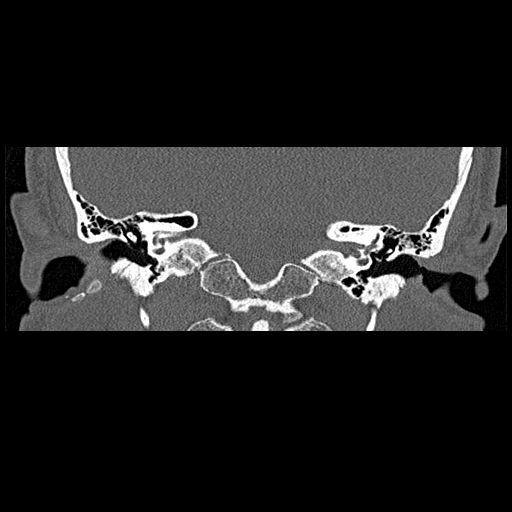 File:Bilateral ossifications of the external auditory canal (Radiopaedia 15233-15076 Coronal bone window 11).jpg