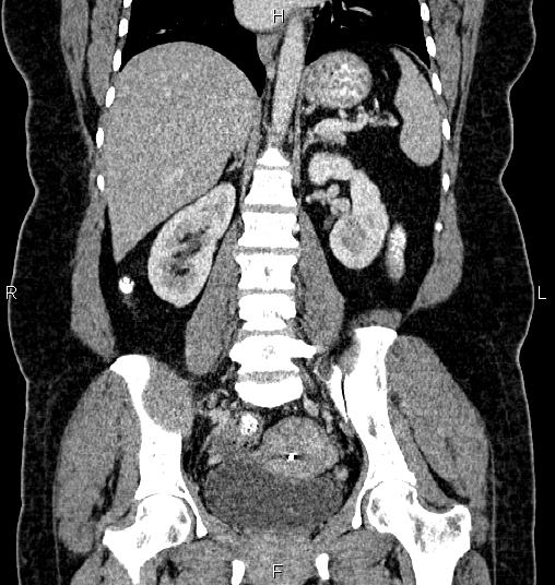 Bilateral ovarian dermoid cysts (Radiopaedia 85785-101603 C 35).jpg