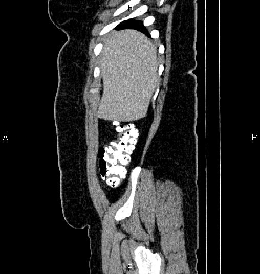 Bilateral ovarian dermoid cysts (Radiopaedia 85785-101603 D 7).jpg