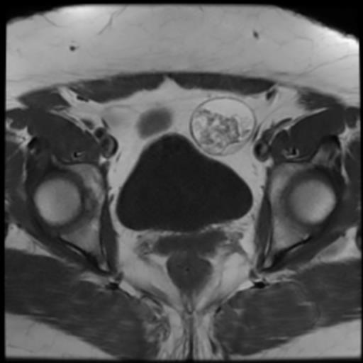 File:Bilateral ovarian dermoid cysts (Radiopaedia 90152-107338 Axial T1 15).jpg