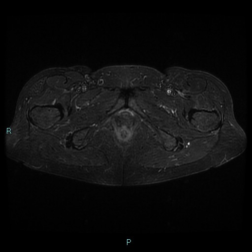 File:Bilateral ovarian fibroma (Radiopaedia 44568-48293 Axial STIR 28).jpg