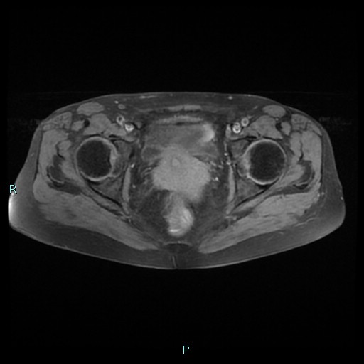 File:Bilateral ovarian fibroma (Radiopaedia 44568-48293 Axial T1 fat sat 20).jpg